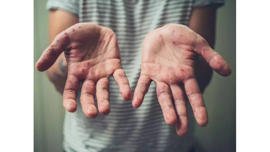 ВОЗ призывает к планам вакцинации против оспы обезьян в Африке