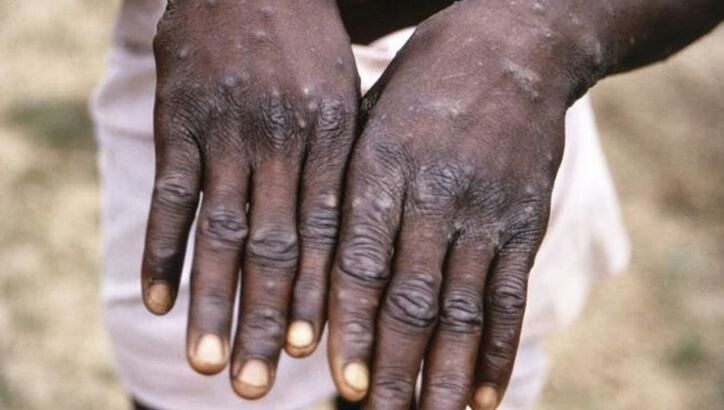 ООН предупреждает о вспышке оспы обезьян в лагерях ДР Конго