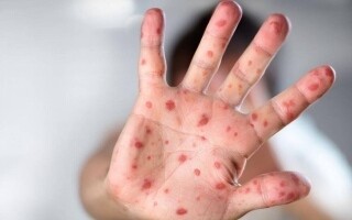 ВОЗ снова объявляет чрезвычайную ситуацию по оспе обезьян