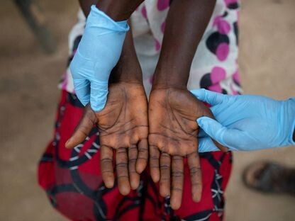 Заражение обезьяньей оспой унесло 548 жизней в ДРК