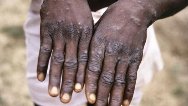 ООН предупреждает о вспышке оспы обезьян в лагерях ДР Конго